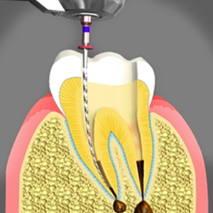 Root Canal Treatment Endodontics